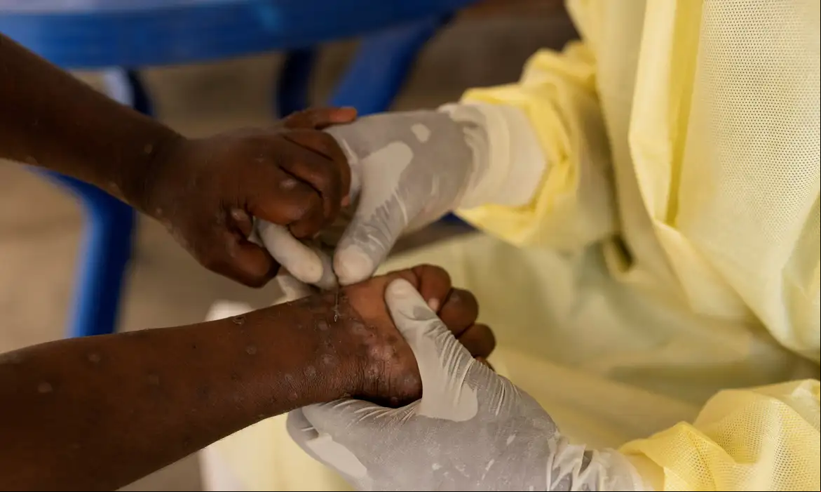 Mpox: OMS pede resposta após registro de nova variante na Suécia